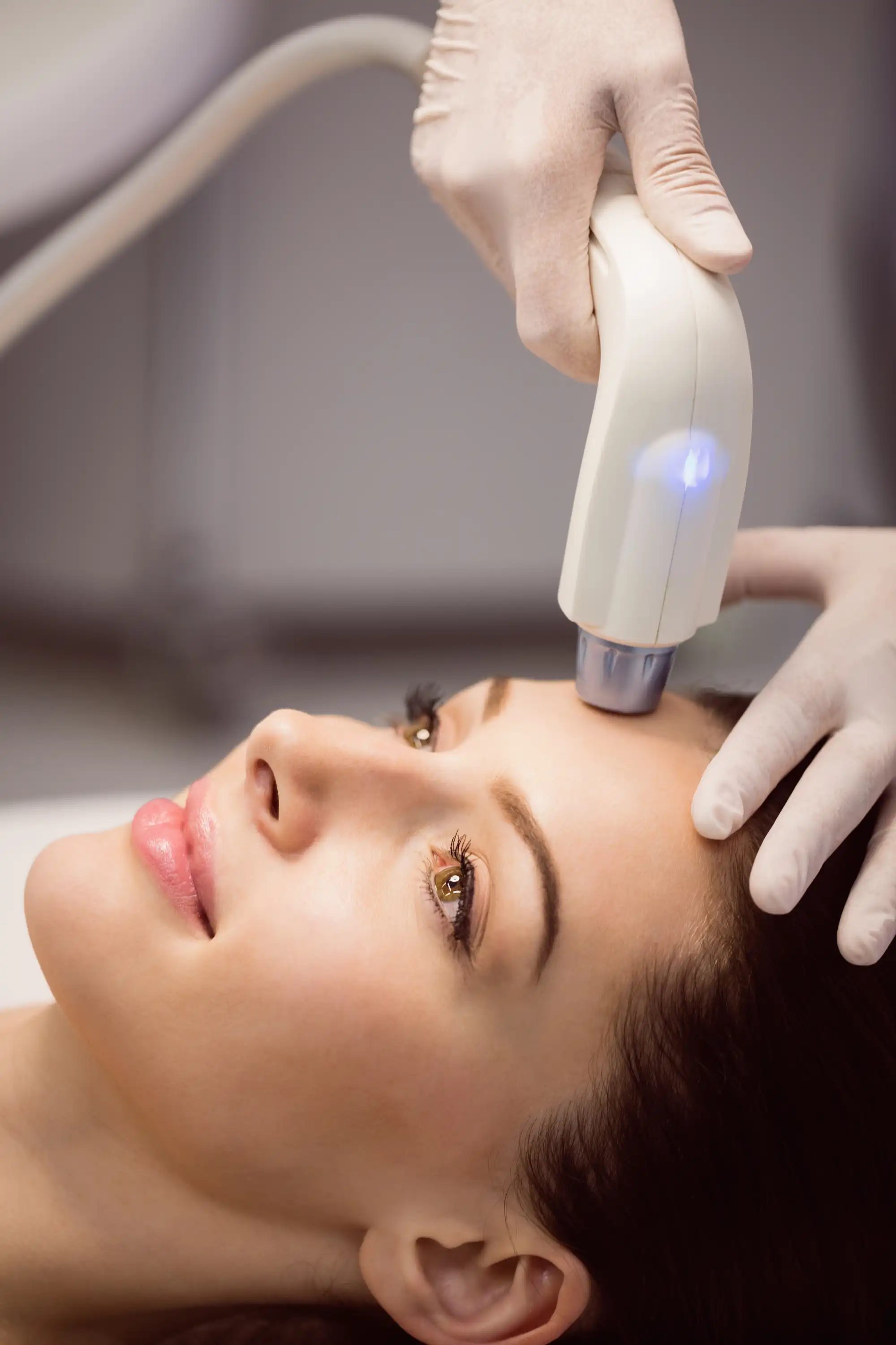 epilazione laser sottomento